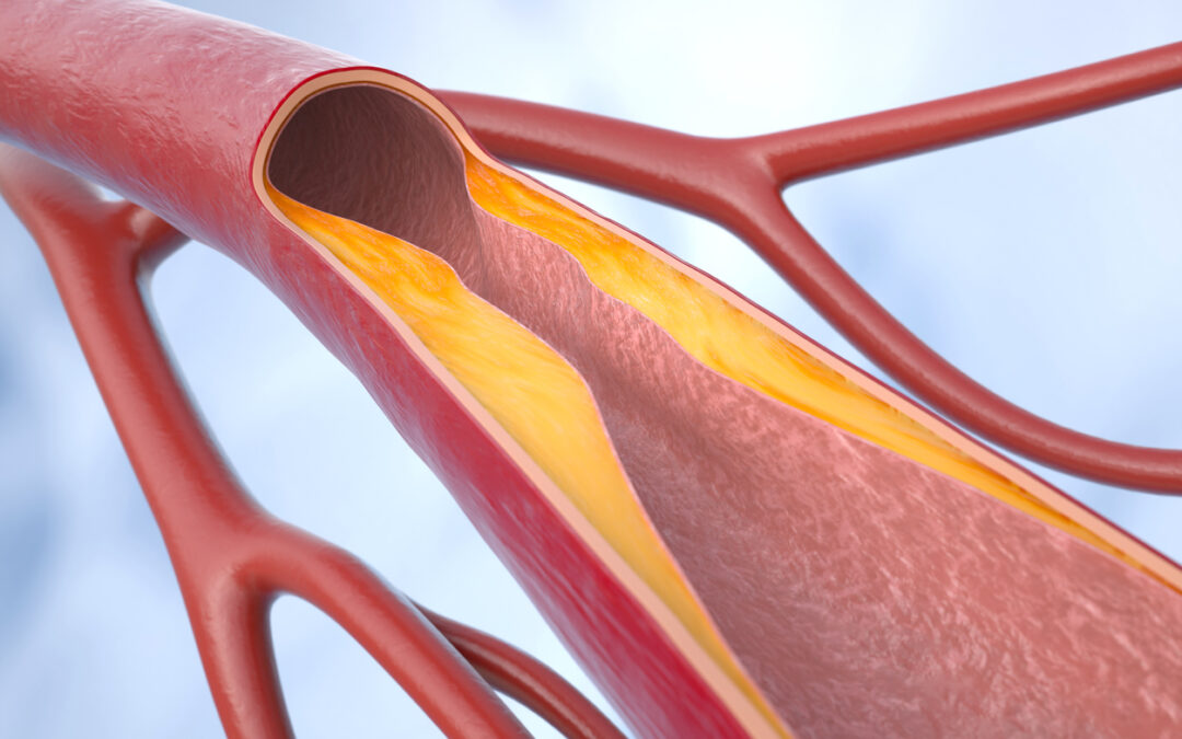 Score de calcio: ¿Conoces tu riesgo coronario?